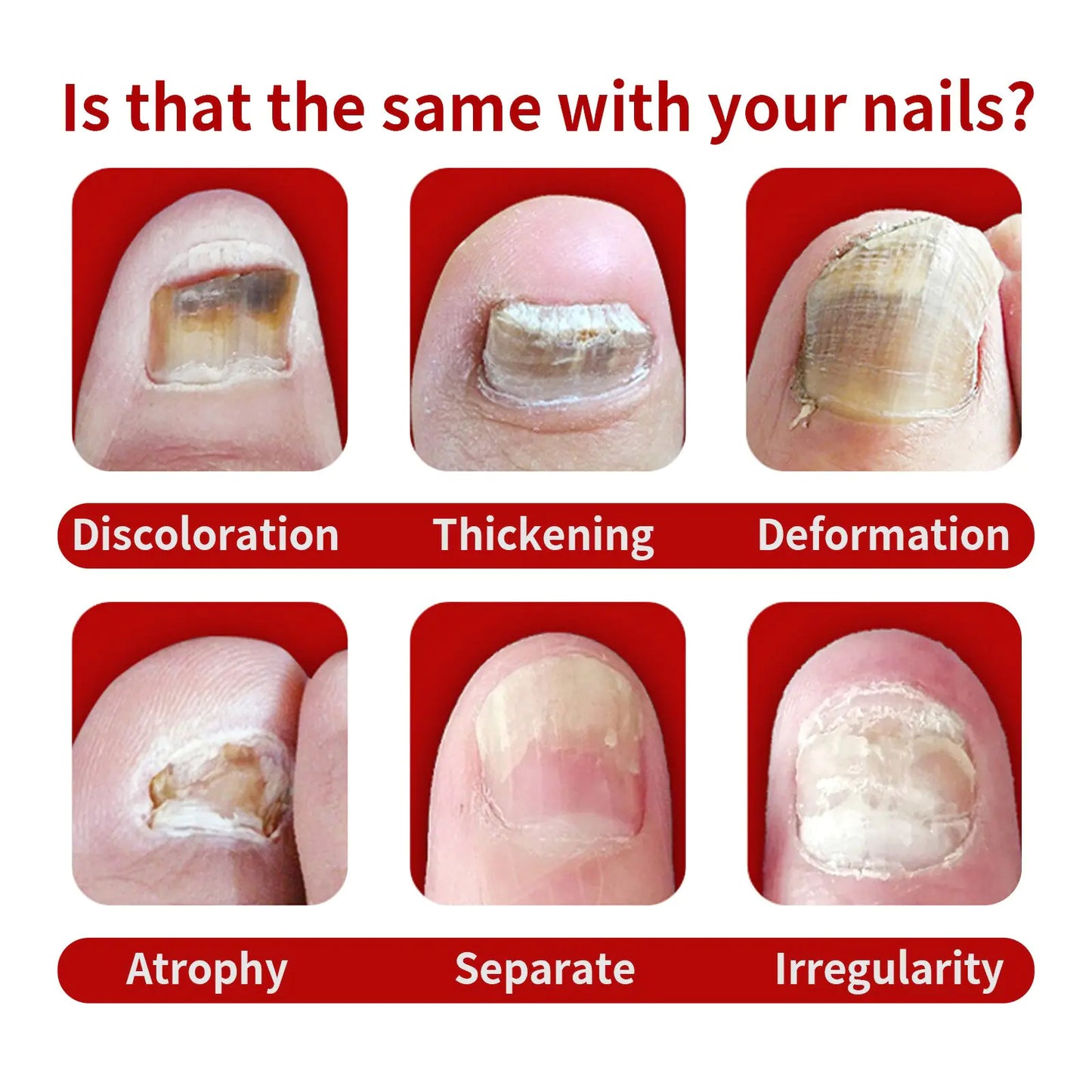 Anti Fungus Relief Oil Treatment Inflammation Nail