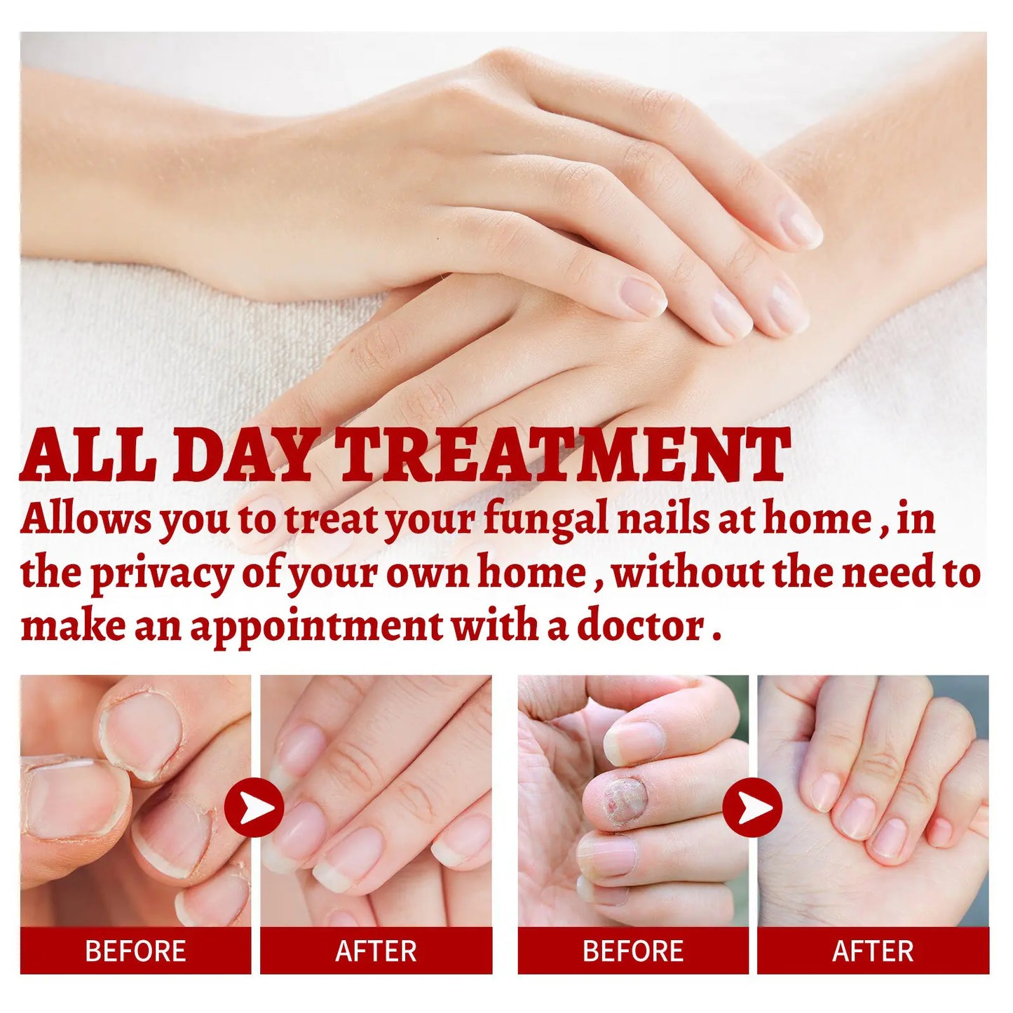 Anti Fungus Relief Oil Treatment Inflammation Nail